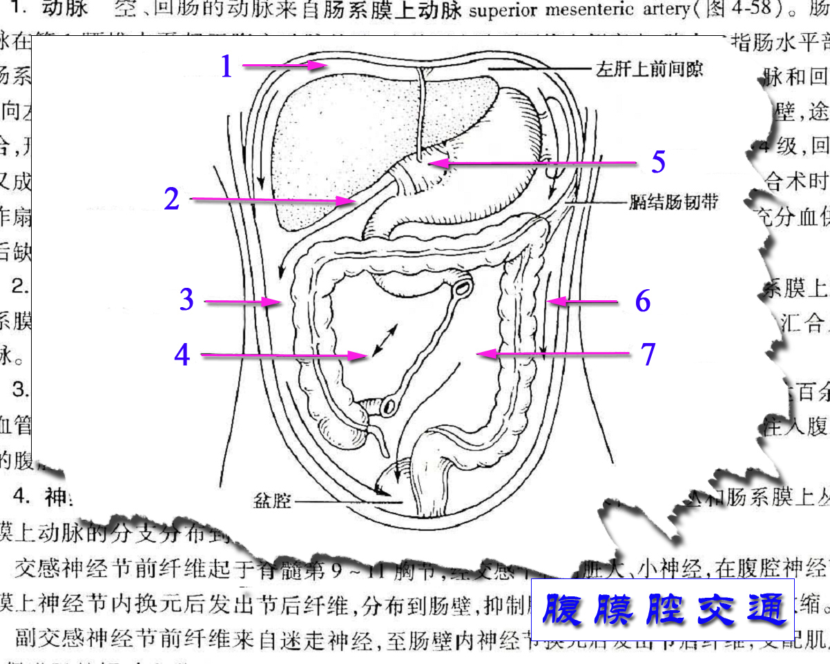 14腹膜腔交通